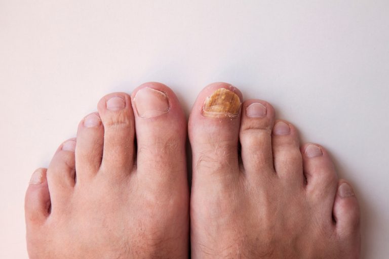 New Treatment For Fungus Toenails Onychomycosis in Baltimore